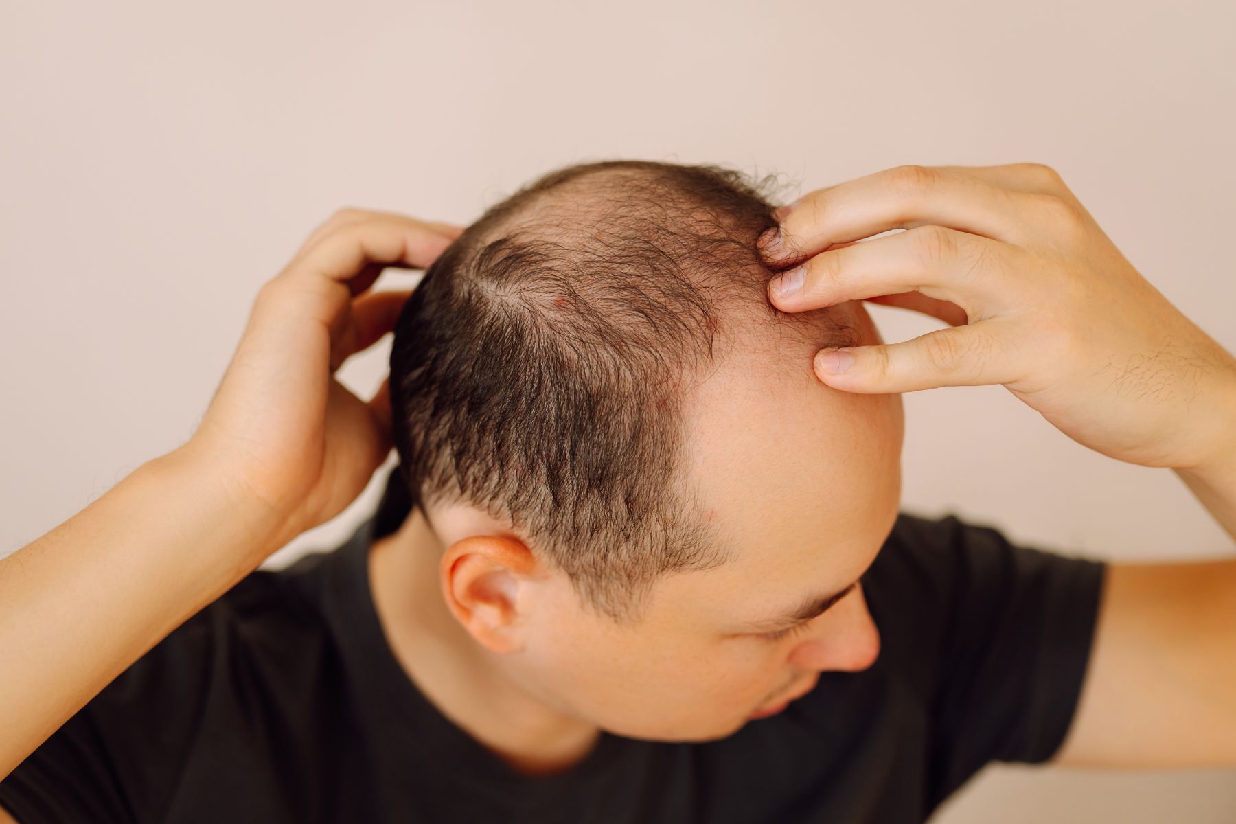 Men’s Confidence: Hair Loss & TRT Support